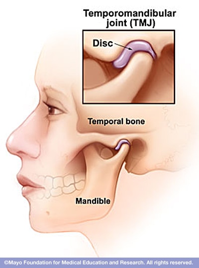 temporomandibular joint syndrome