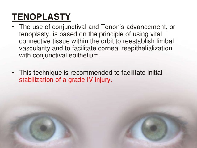 tenoplasty