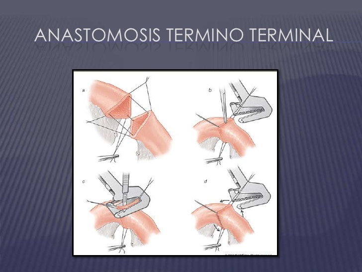 termino-terminal anastomosis