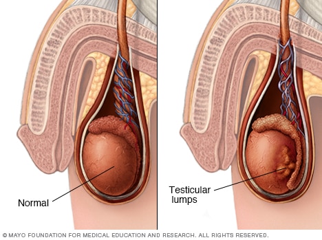 testicular