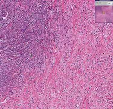 theca-cell tumor