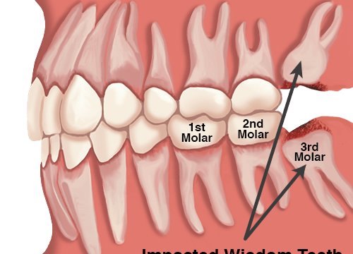 third molar