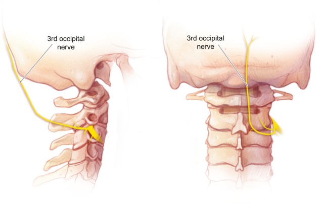 third occipital nerve