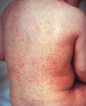 three-day measles