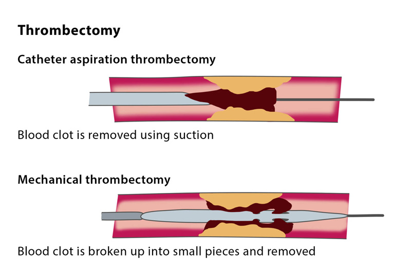 thrombectomy