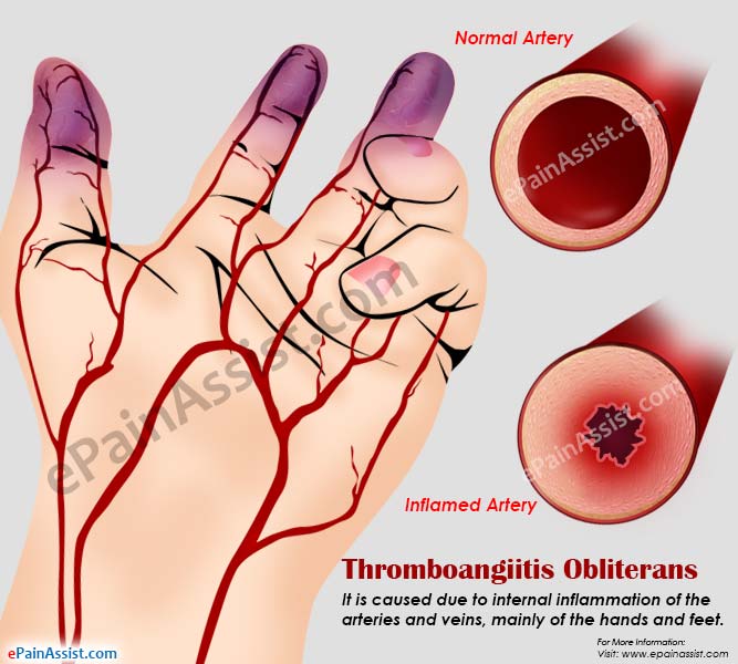 thromboangiitis obliterans