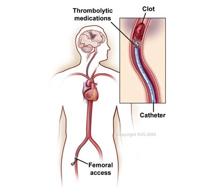thromboclasis