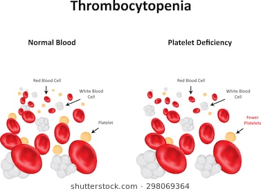 thrombopenia