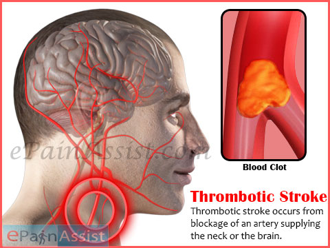 thrombotic