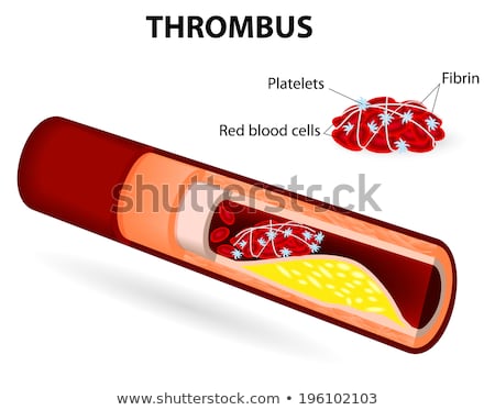 thrombus