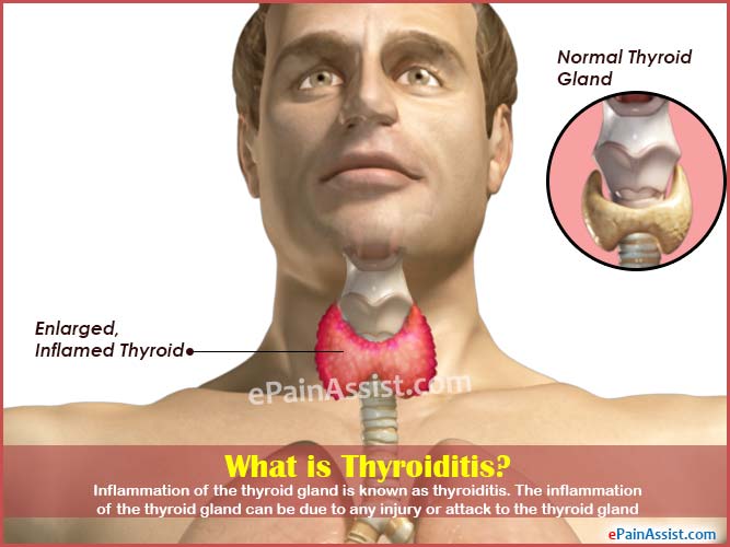 thyroadenitis