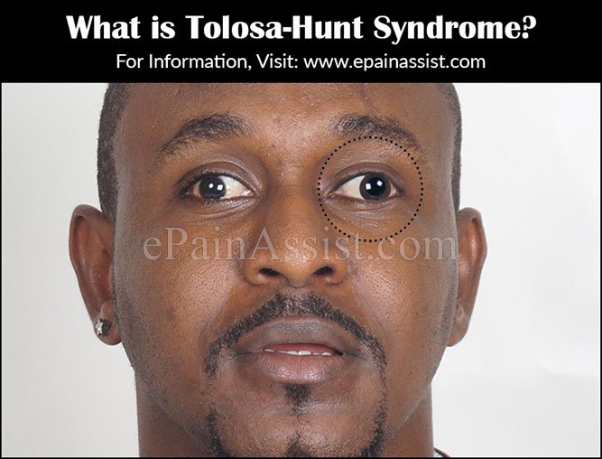 tolosa-hunt syndrome