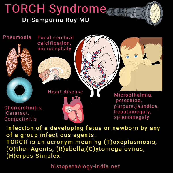 TORCH syndrome