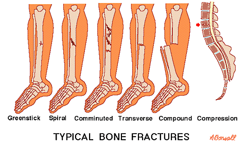 torsion fracture