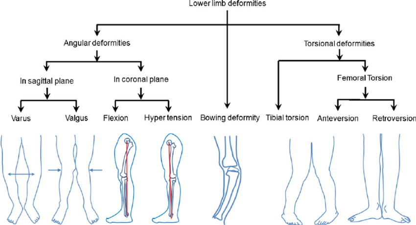 torsional deformity