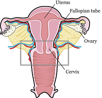 trachelectomy