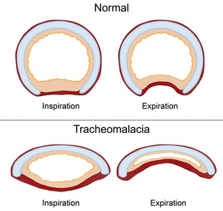 tracheomalacia
