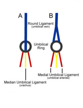 umbilical ring
