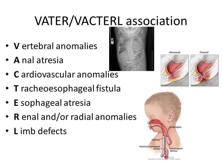 vacterl syndrome