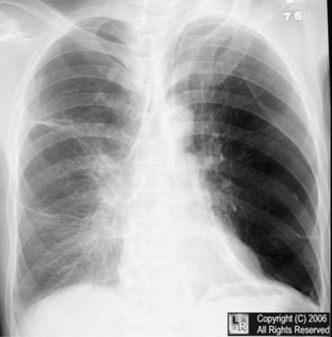vanishing lung syndrome