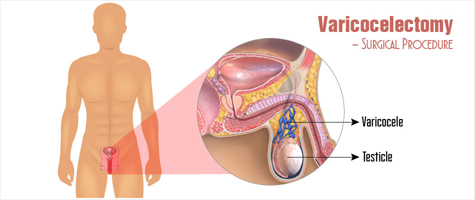 varicocelectomy