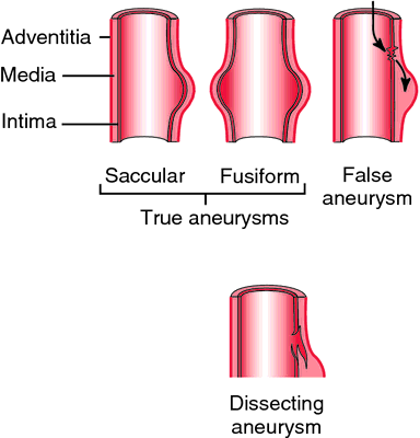 varicose aneurysm