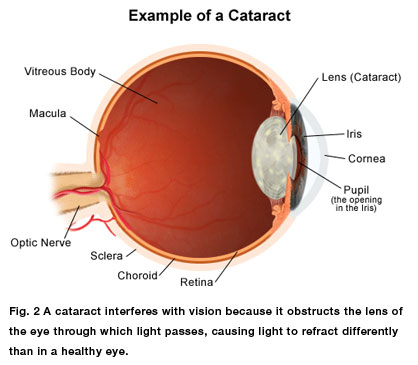 vascular cataract