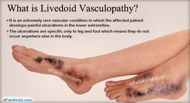 vasculopathy