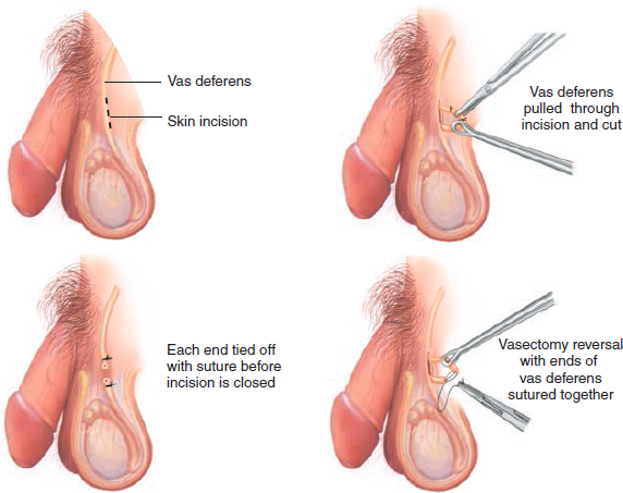 vasovesiculectomy