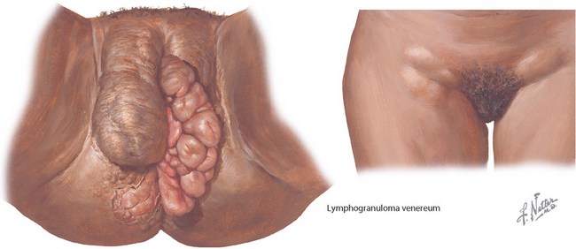 venereal lymphogranuloma