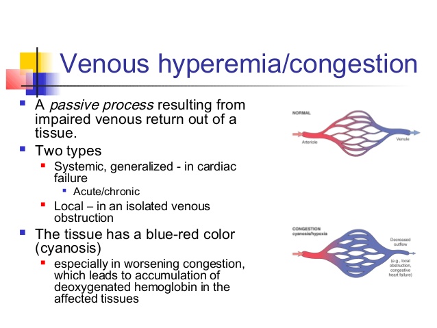 venous hyperemia