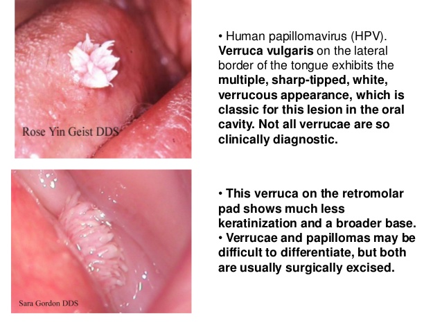 Human papillomavirus facial warts