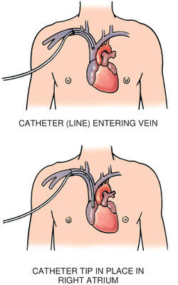vertebrated catheter