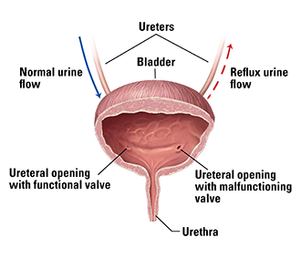 vesicoureteral valve