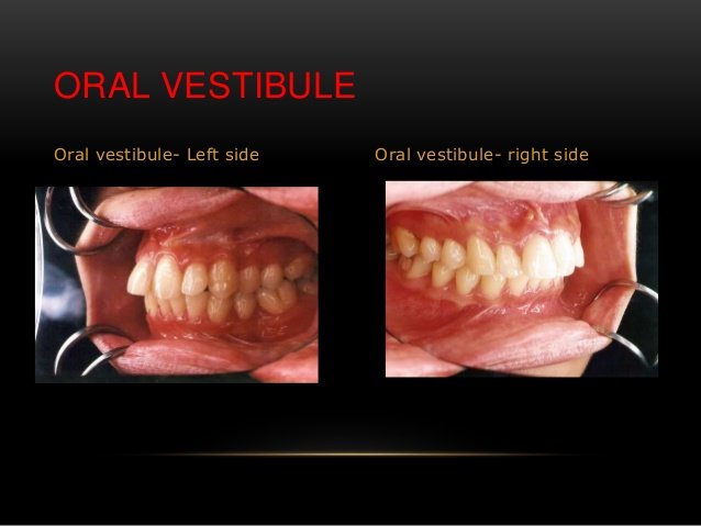 vestibule of mouth