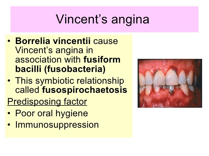 vincent's angina