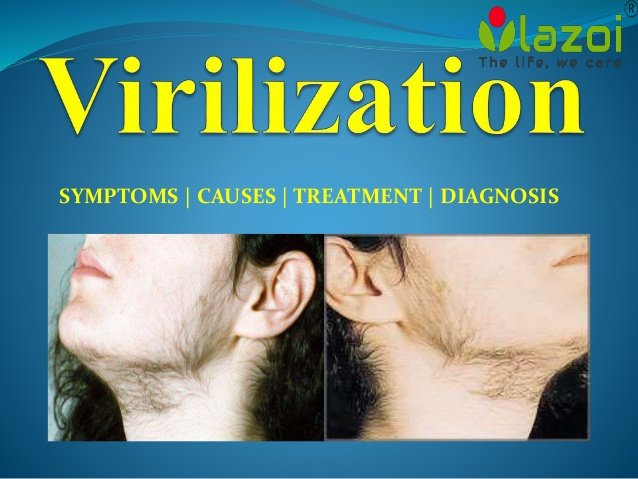 virilization