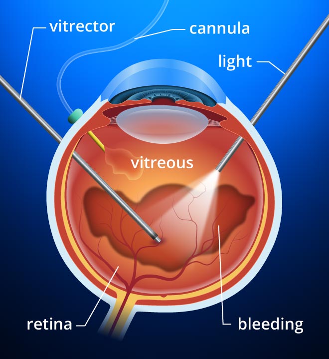 vitreoretinal