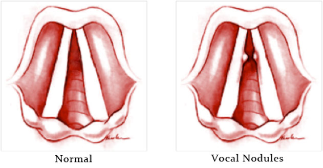 vocal cord nodules