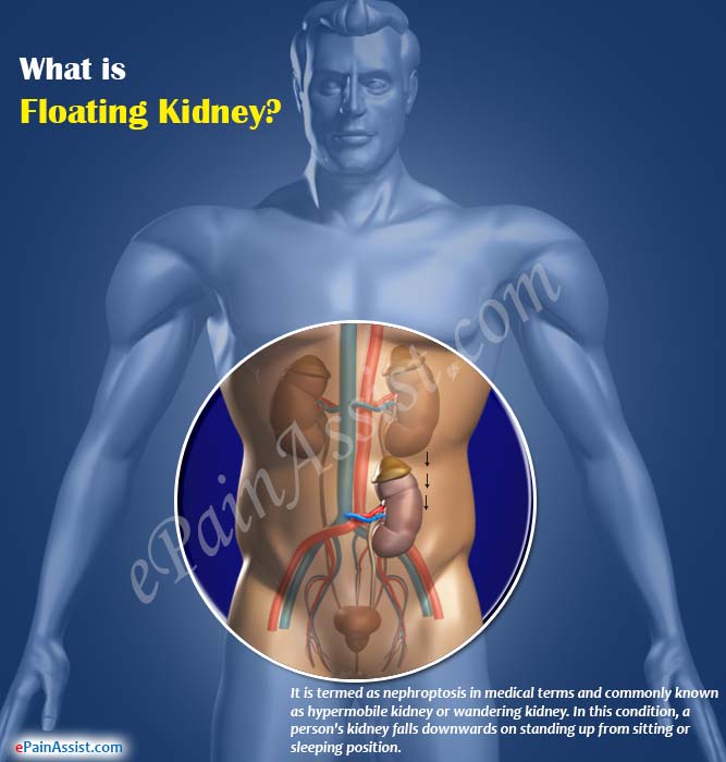 wandering kidney