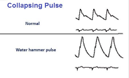water-hammer pulse