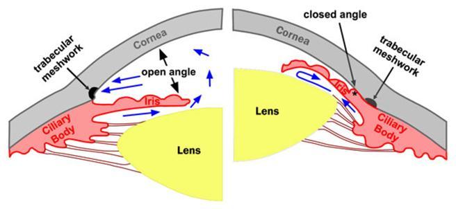wide-angle glaucoma