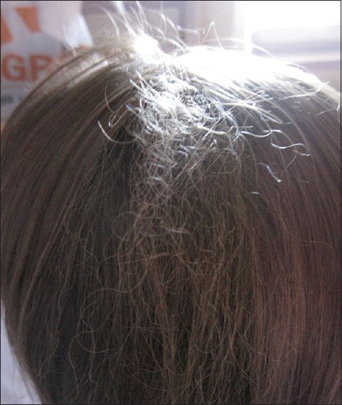 woolly-hair nevus