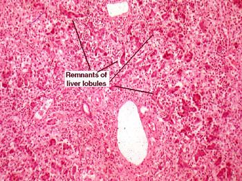 yellow atrophy of liver