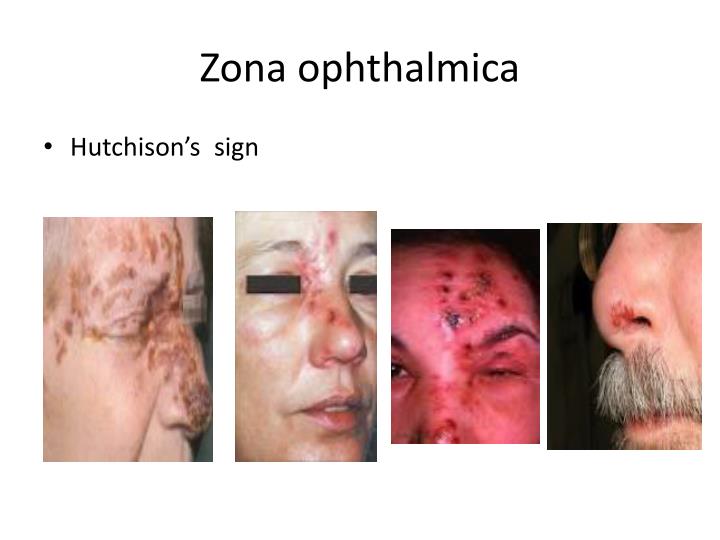 zona ophthalmica
