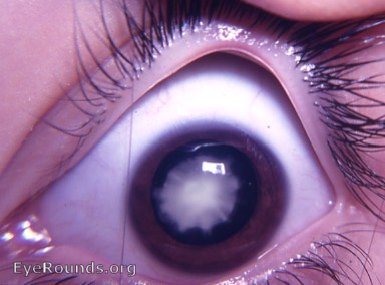 zonular cataract