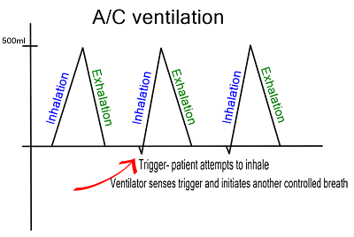 assist-control ventilation
