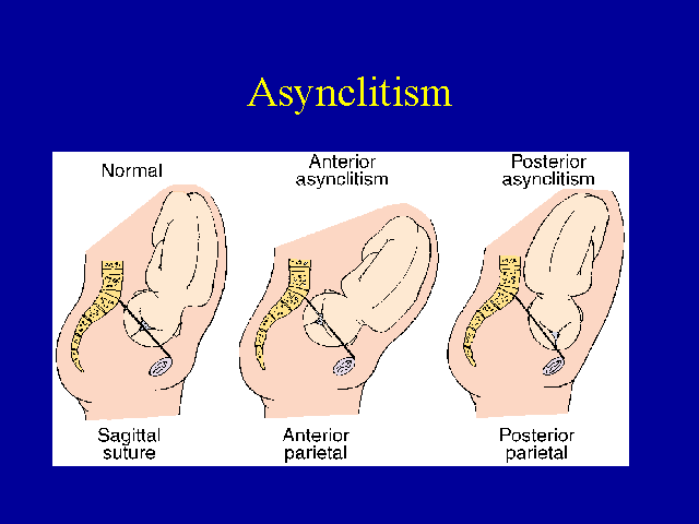 asynclitism