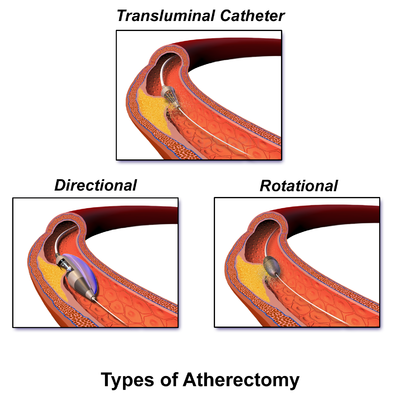 atherectomy