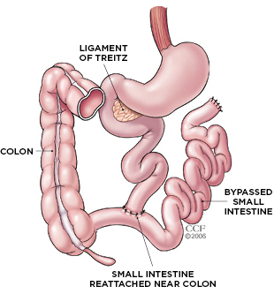bowel bypass